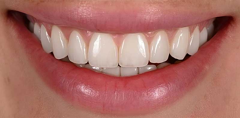 After Veneers