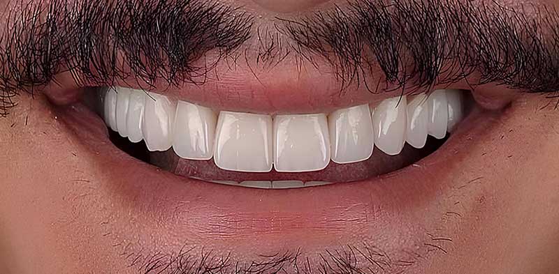 After Veneers
