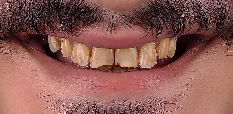 Before Veneers