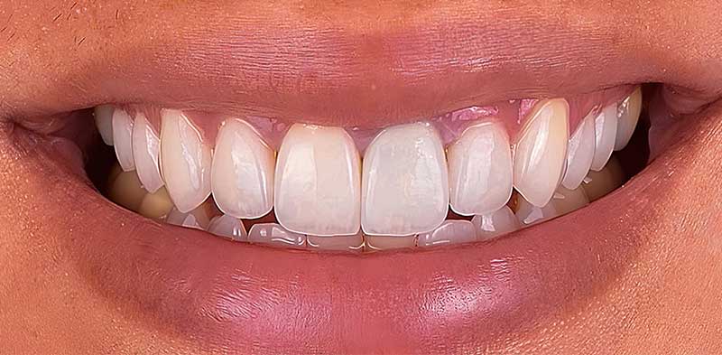 After Veneers