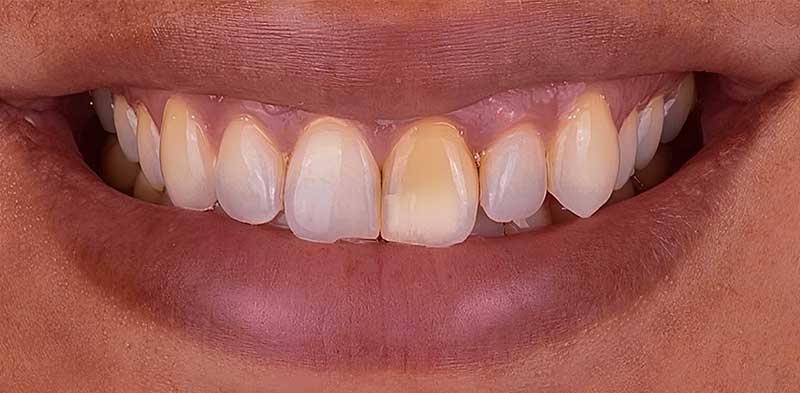 Before Veneers