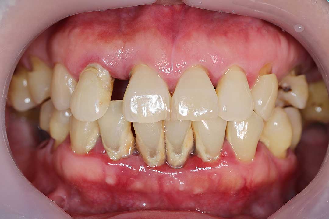 Gum disease
