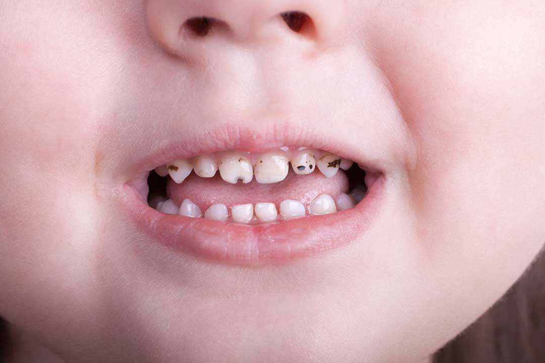 Cavities treatment in toddler