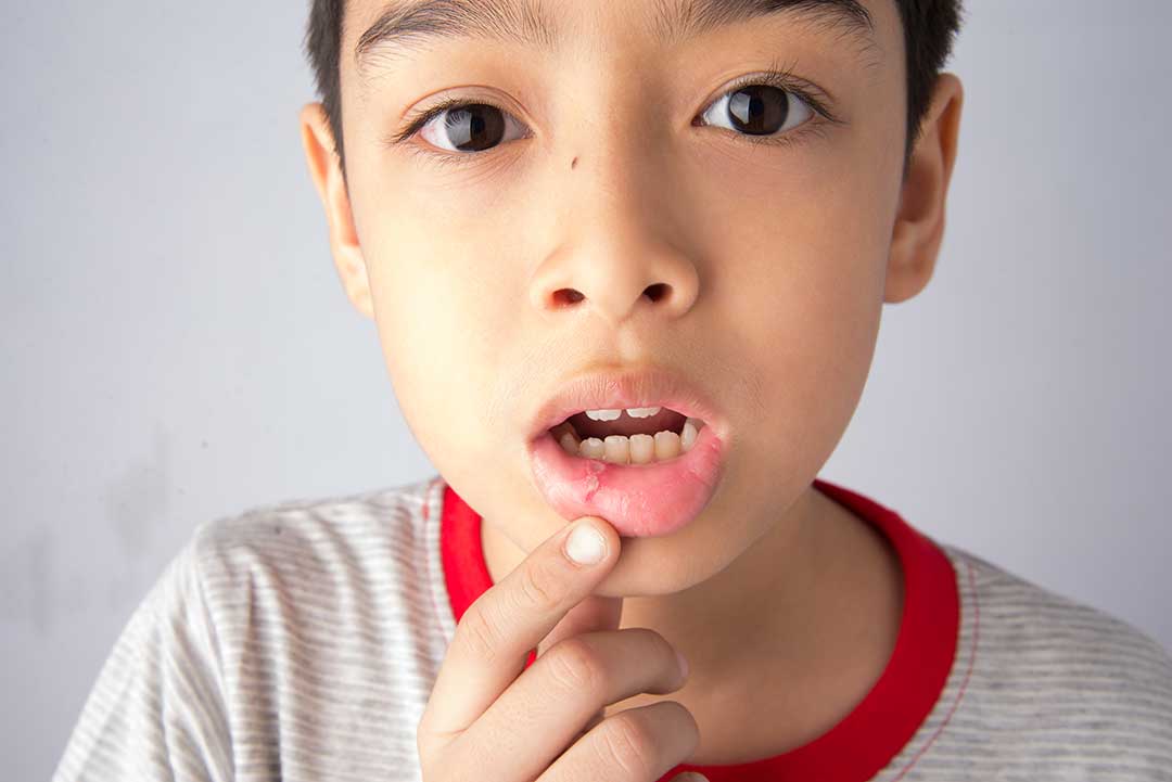 How to Treat Children’s Mouth Ulcers – A Guide for Parents
