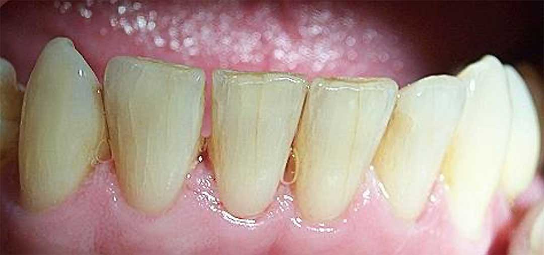 Tooth crack