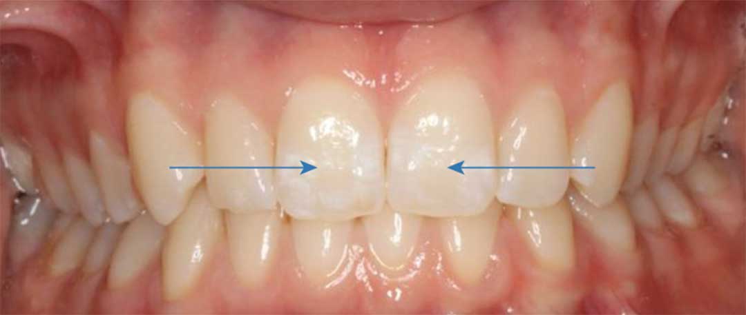 Dental Fluorosis