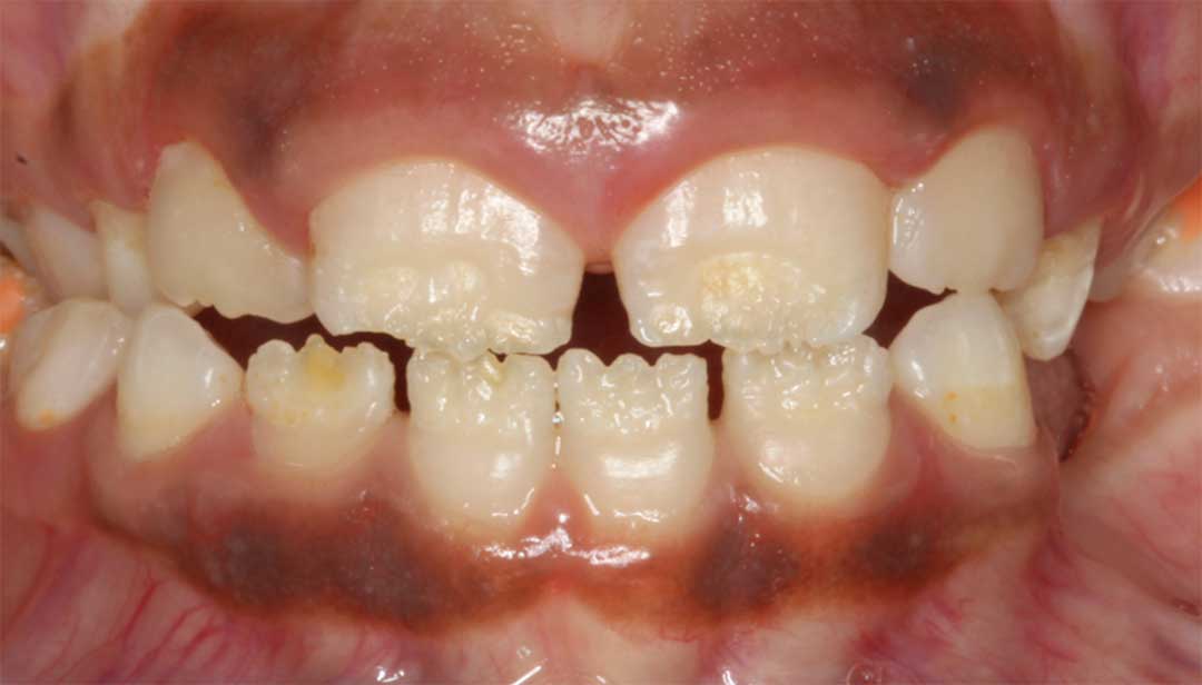 Enamel Hypoplasia