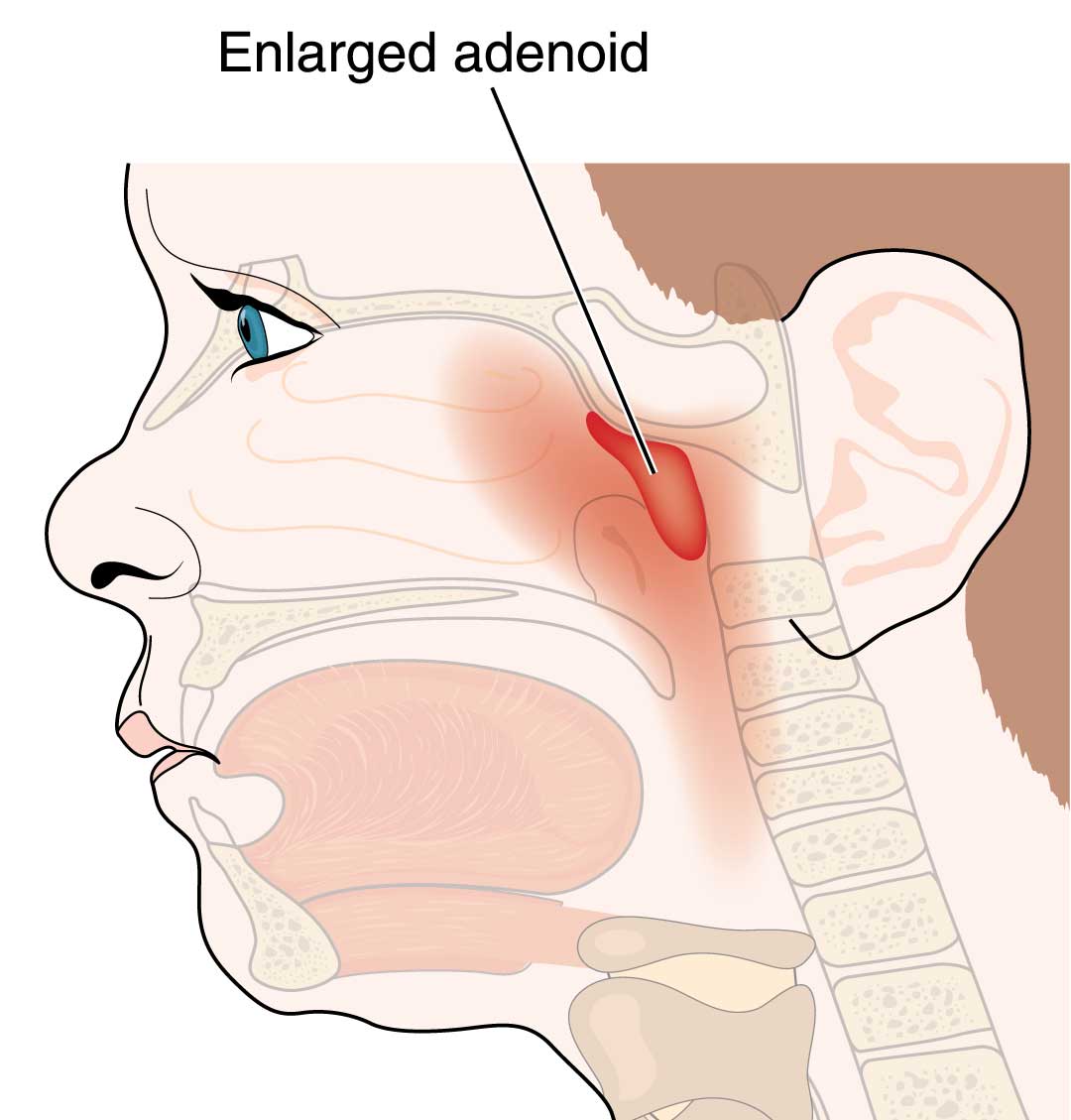 Enlarged adenoid