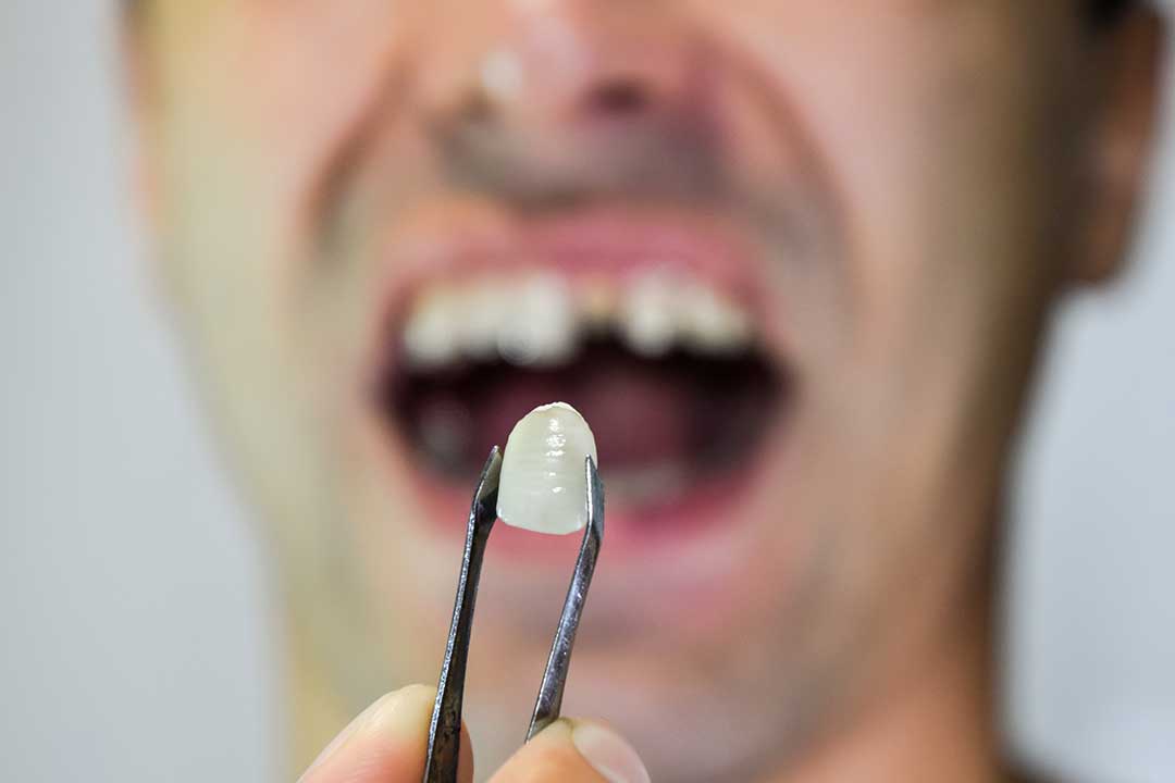 Can Veneers Fill in Missing Teeth?