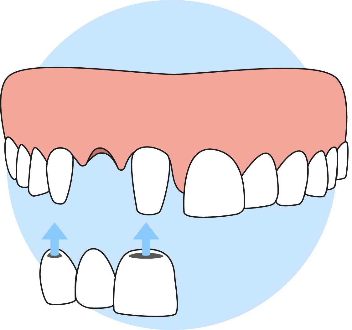 Dental Bridge