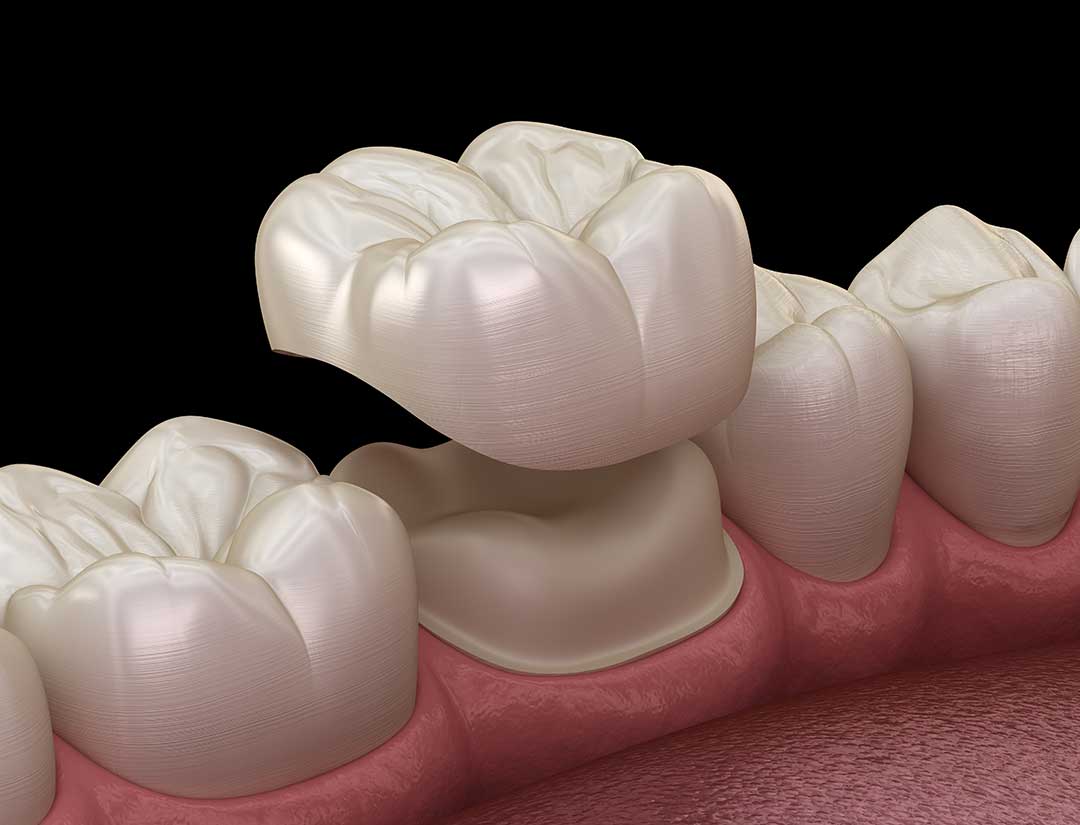 Dental Crown