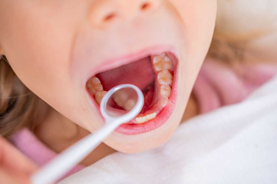 How Long Do Dental Sealants Last?