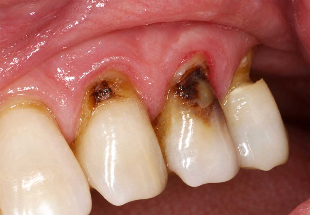 Root caries on an exposed tooth root