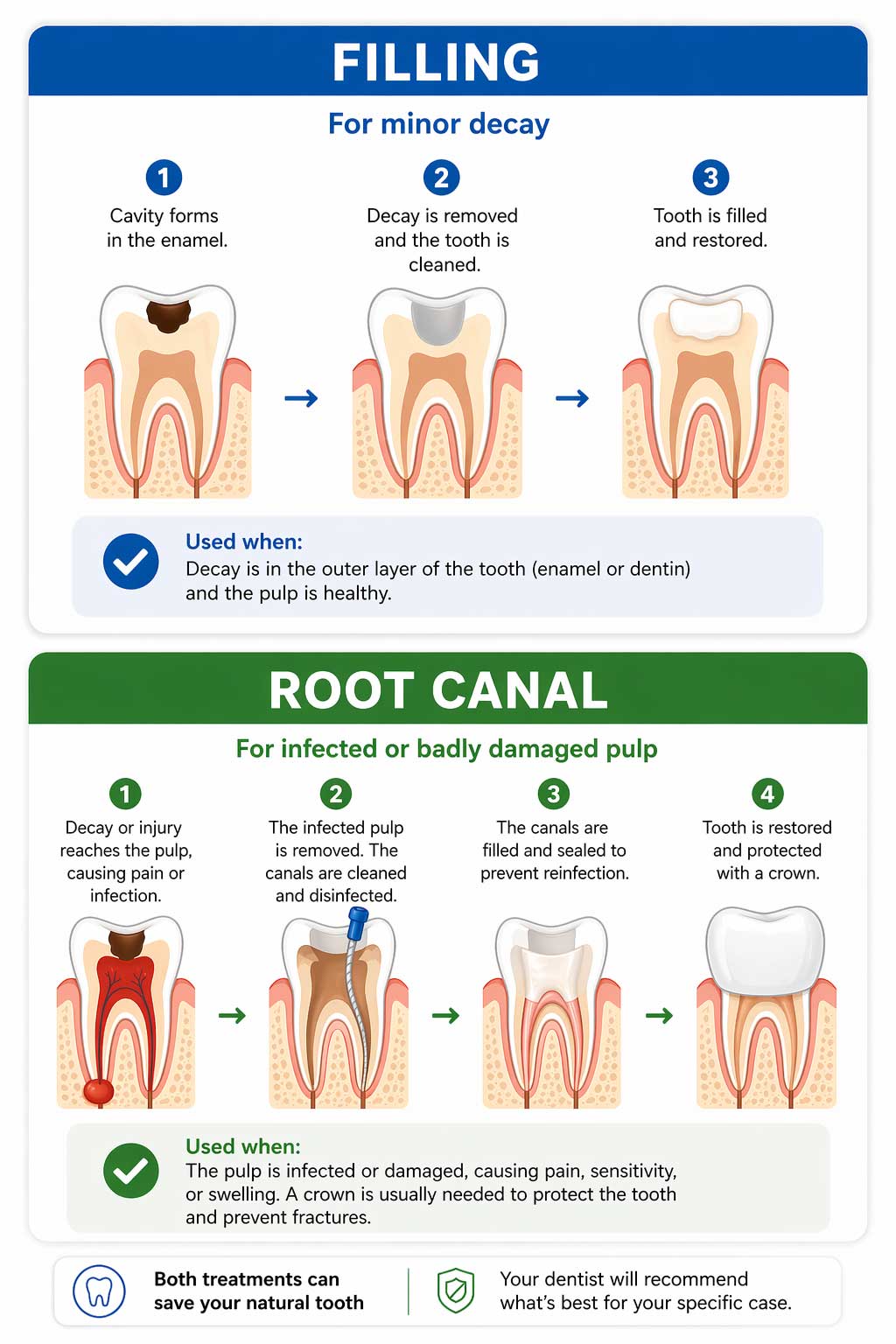 Filling vs Root Canal