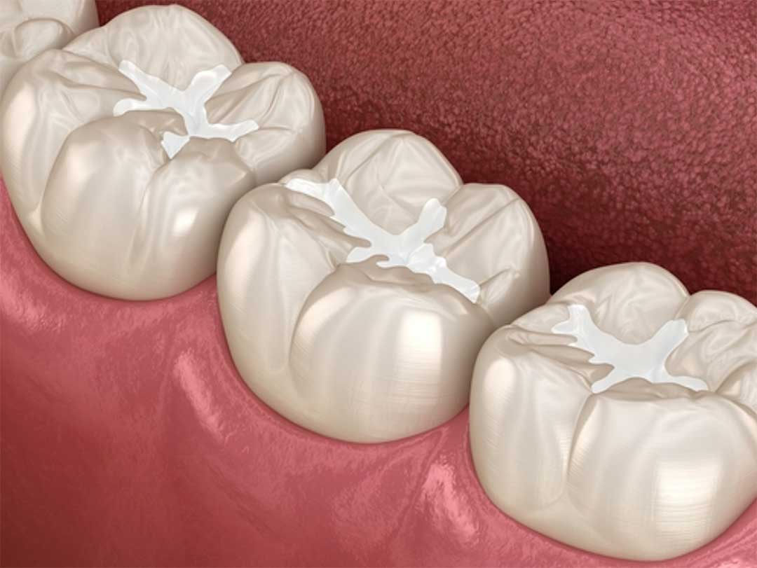 What Are Fissure Sealants and Does Your Child Need One?