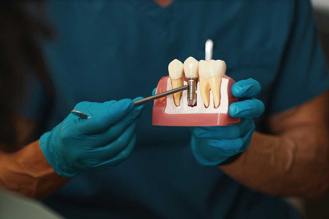 What Affects How Long Dental Implants Last