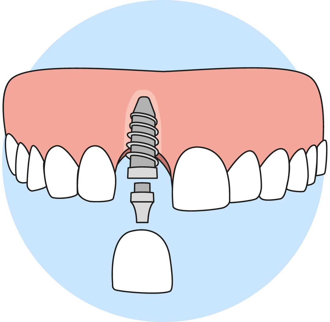 Dental Implant