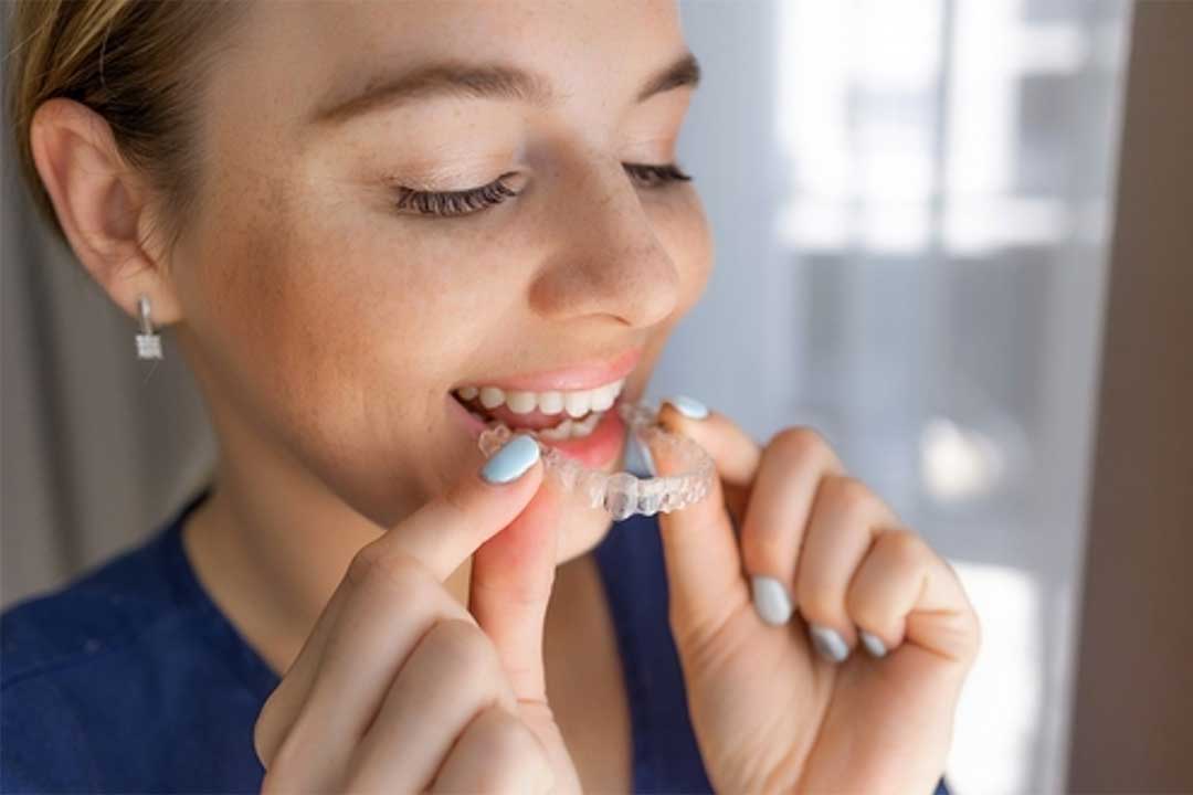 How Long Does Invisalign Take? What to Expect at Each Stage