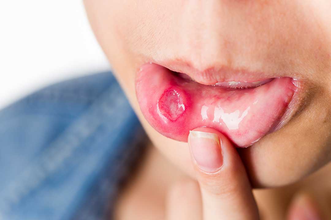 Mouth Ulcers: Symptoms, Treatment & When to See a Dentist