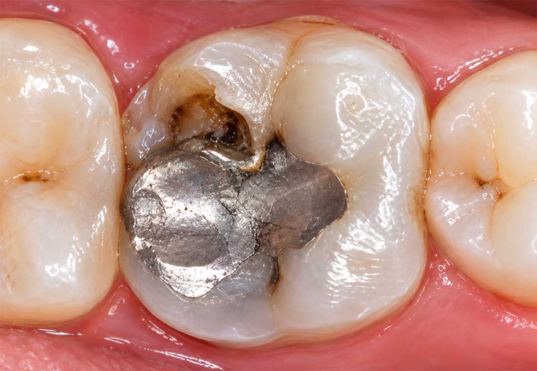 Tooth decay under an old dental filling