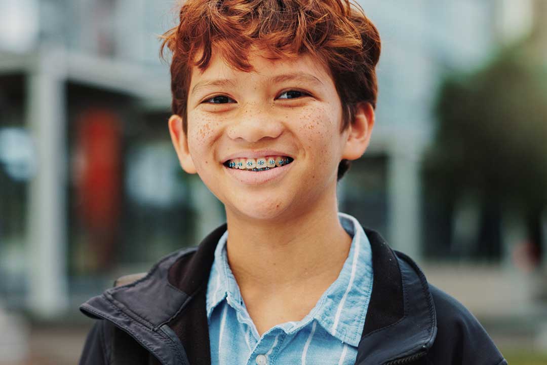 Are Extractions Needed for Orthodontic Treatment?