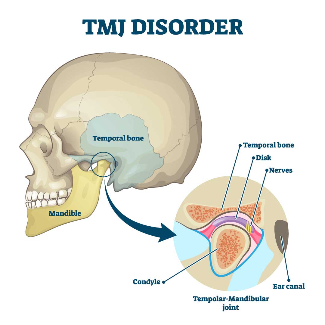 TMJ Disorder Illustration