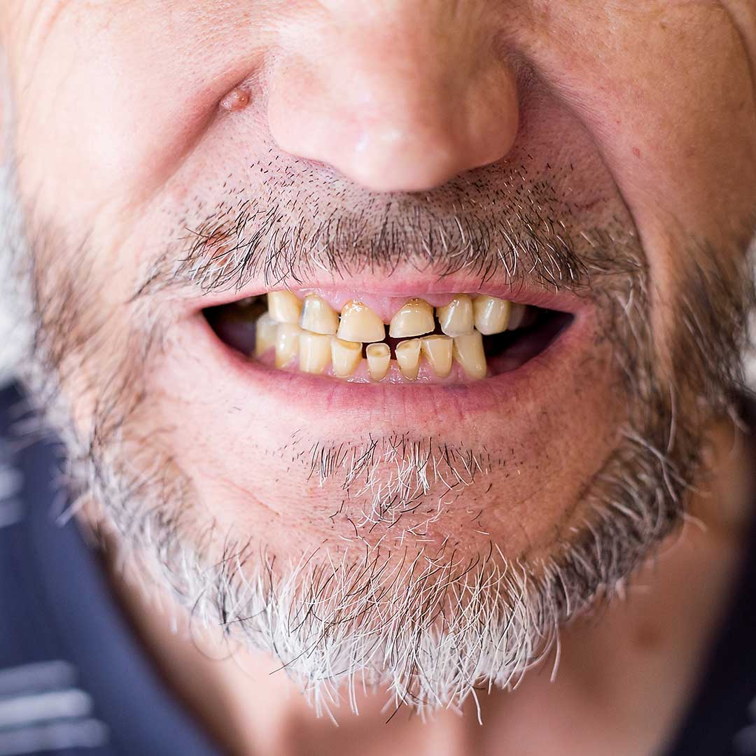 Dental Abrasion: Causes, Symptoms & Treatment