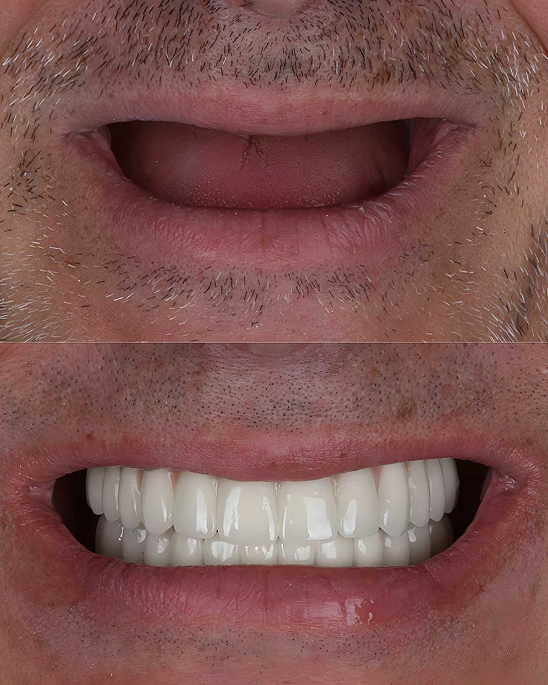 All-on-4 Dental Implants