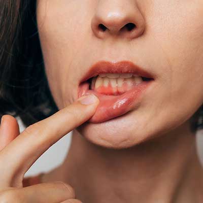 Gum Recession Treatment