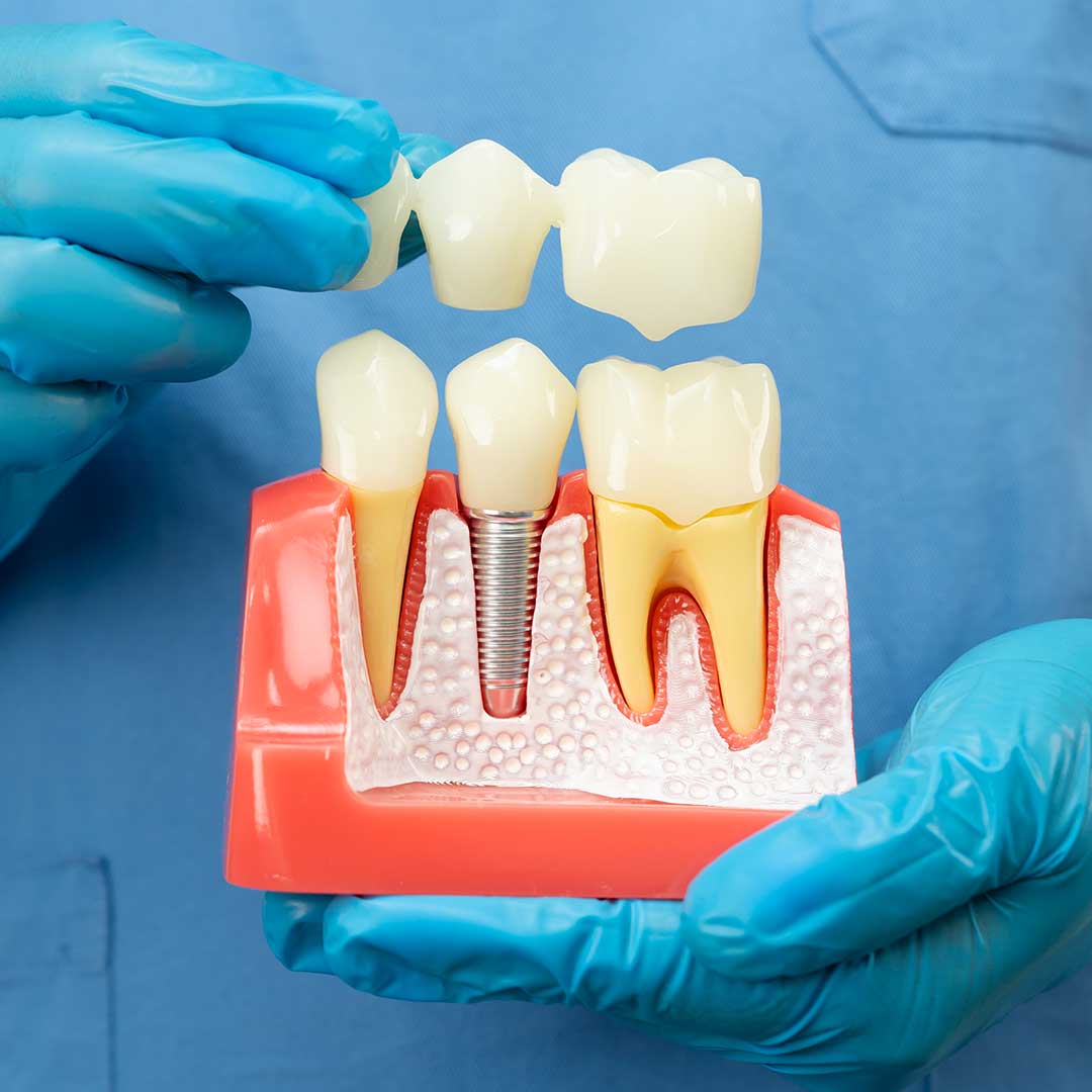 Dental Crowns