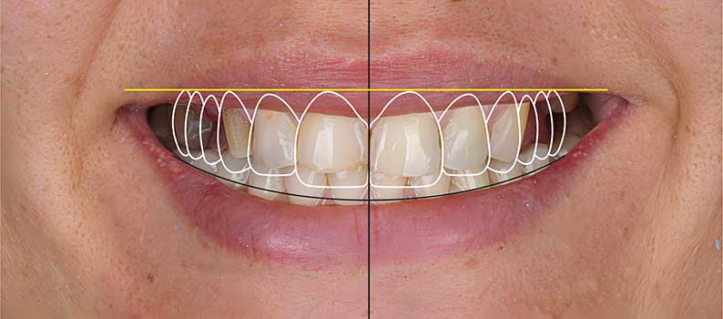 Digital Smile Design