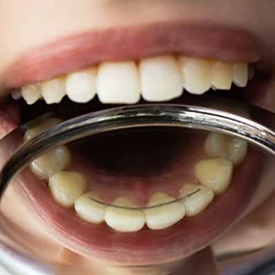 Fixed (Bonded) Retainers