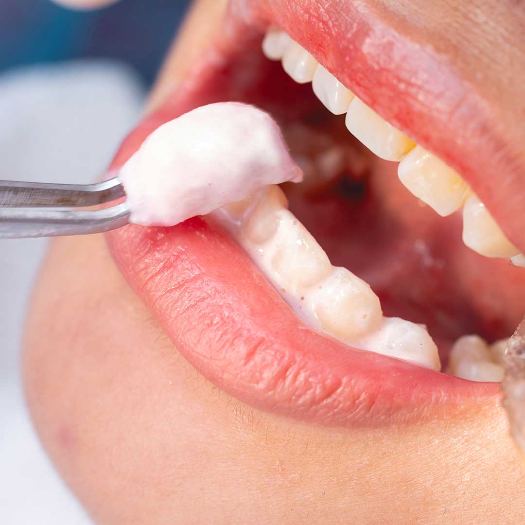 Fluoride Treatment