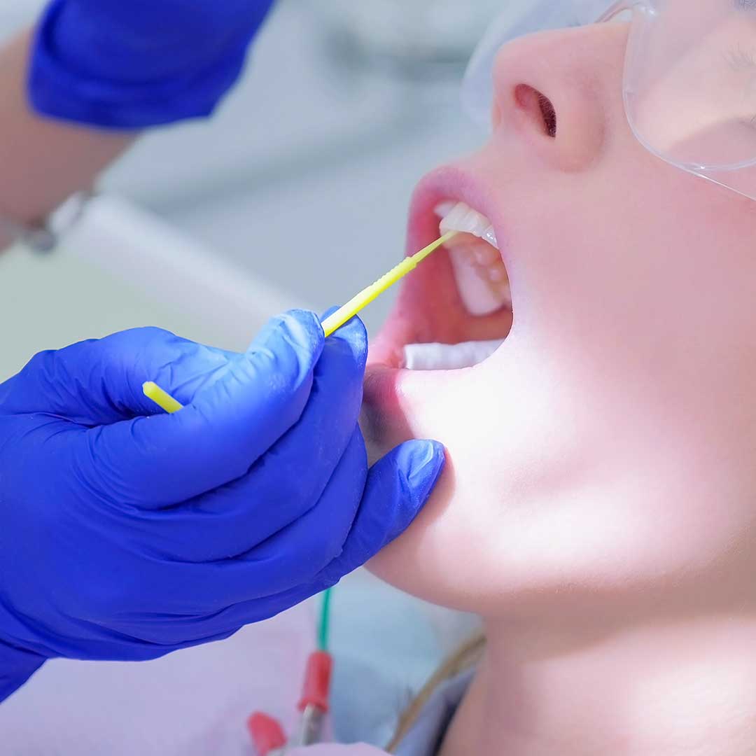 Fluoride Treatment