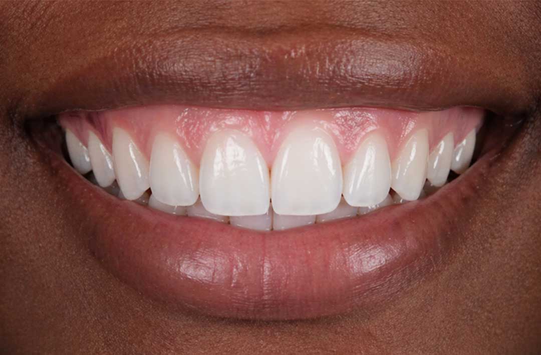 After Gum Depigmentation