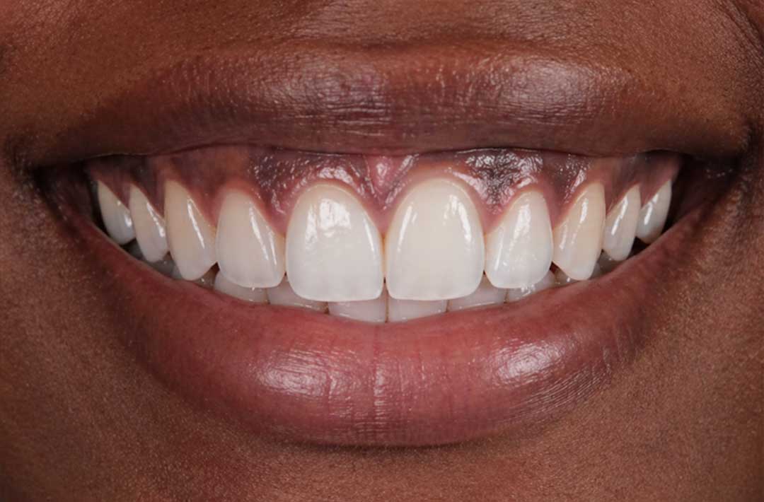 Before Gum Depigmentation