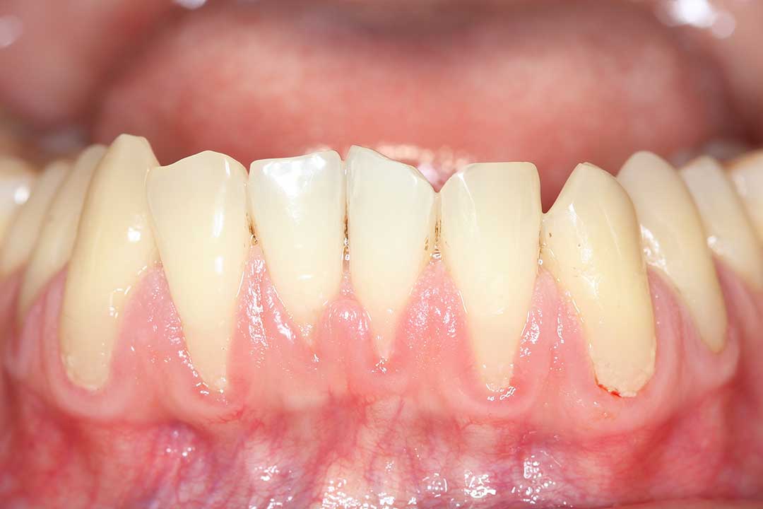 Gum Recession Treatment