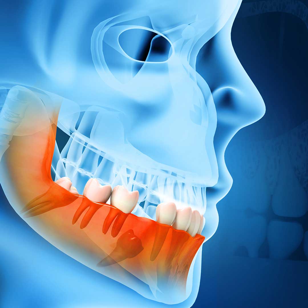 Types of impacted tooth