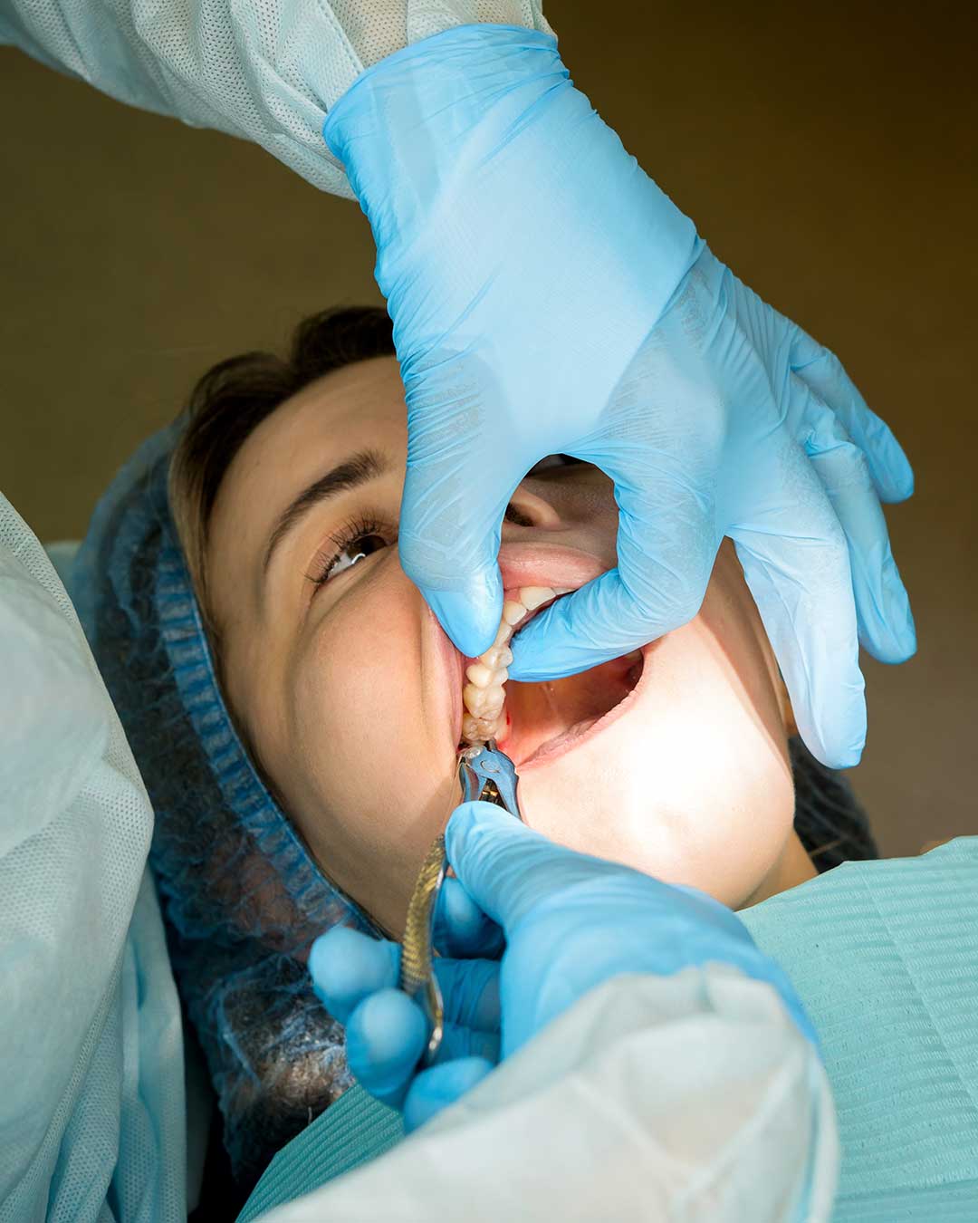 Impacted Tooth Extraction