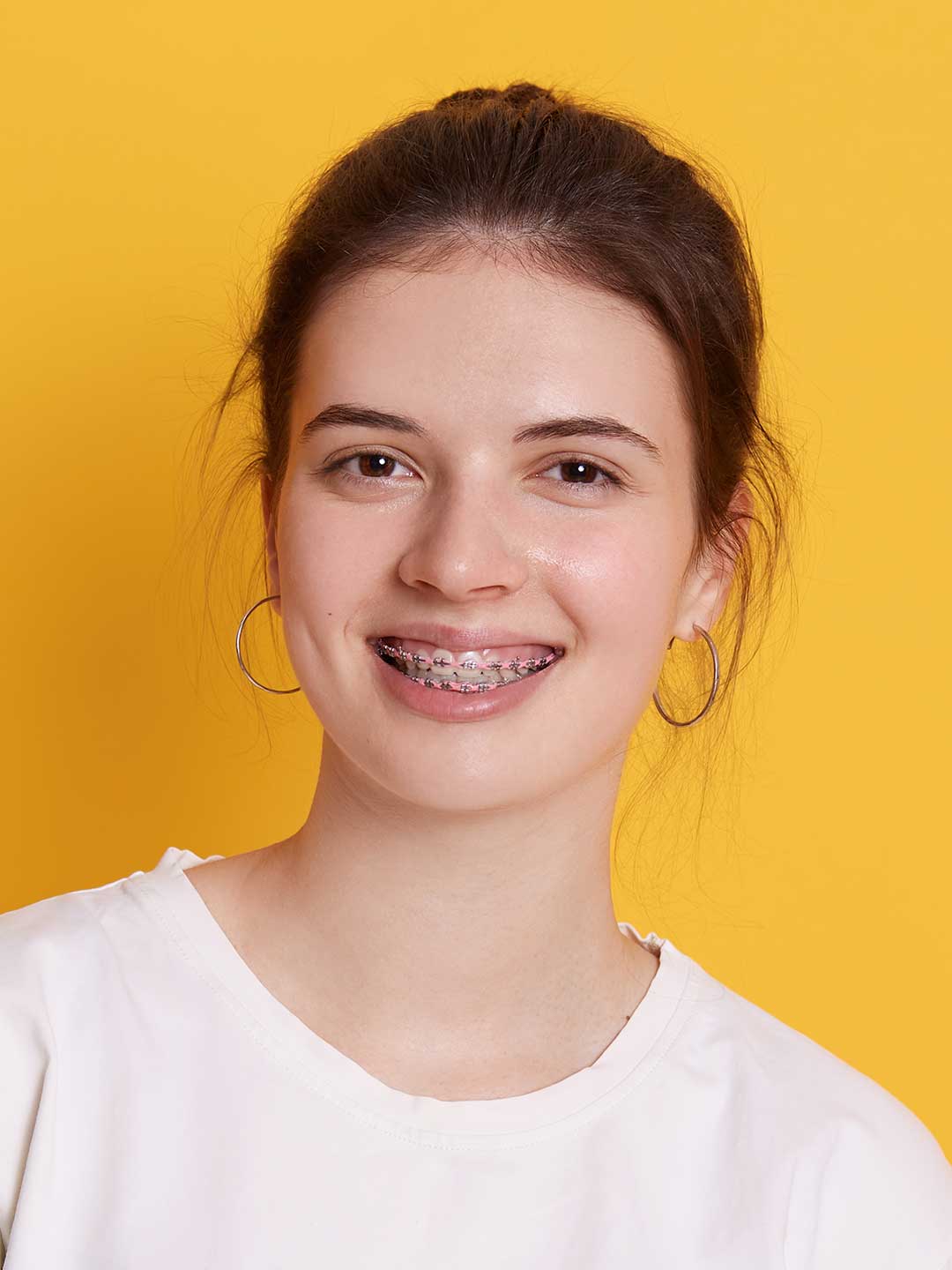 Metal Braces in Dubai