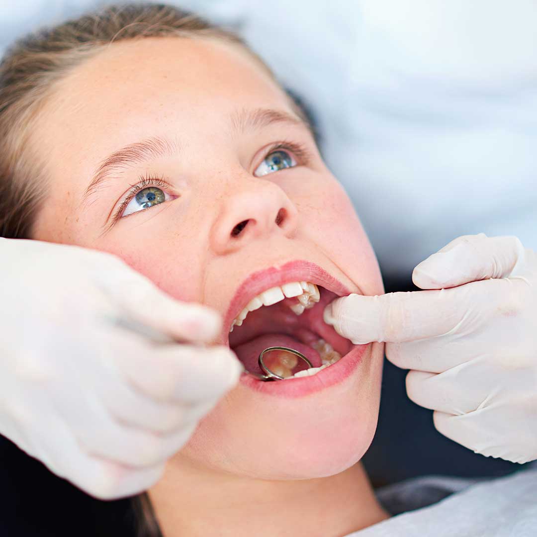Composite Crowns for Children