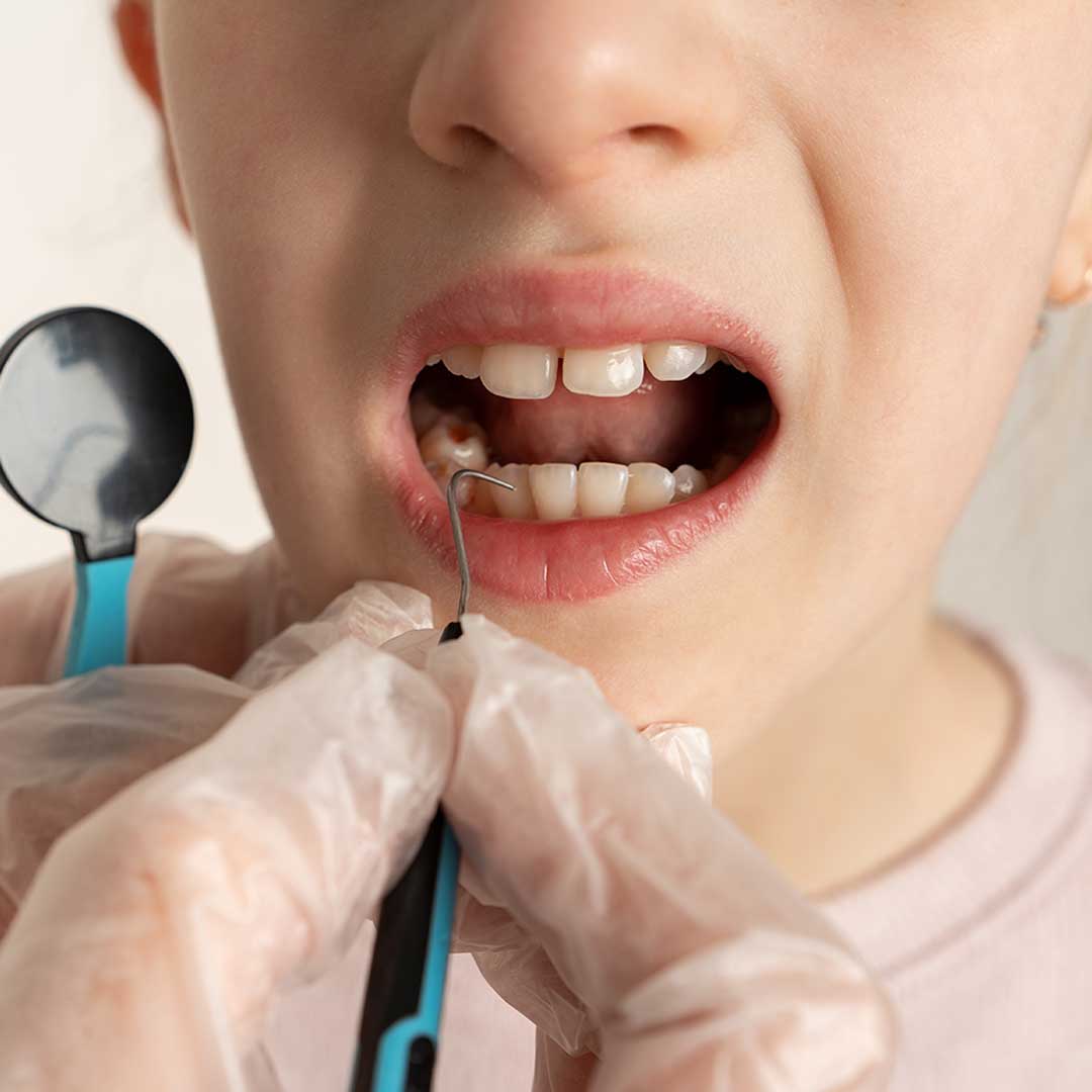 Pulpotomy for Children