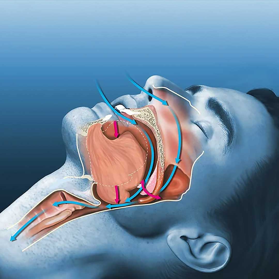 Sleep Apnea Treatment