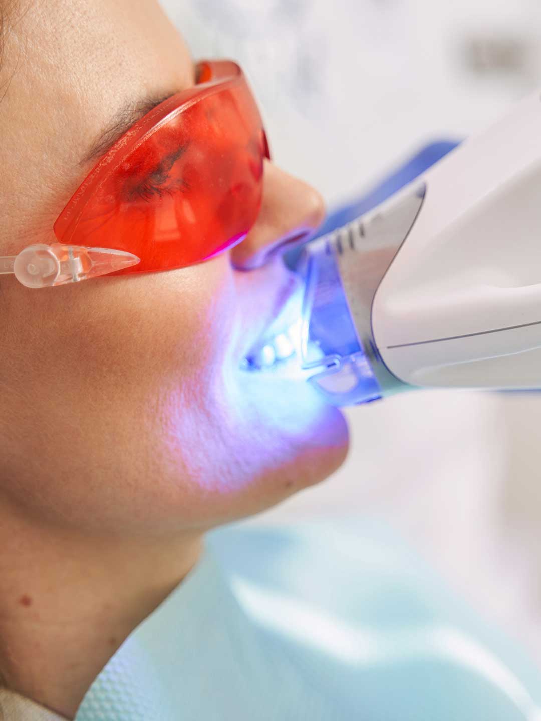 Zoom Teeth Whitening in Dubai
