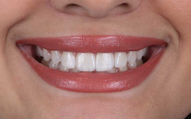 After Veneers