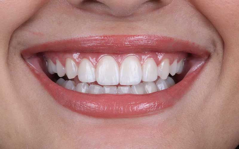 After Veneers