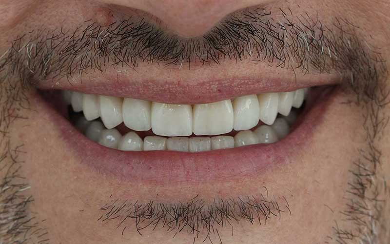 After Veneers
