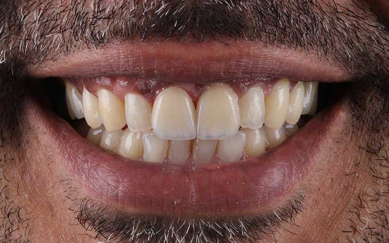 After Veneers