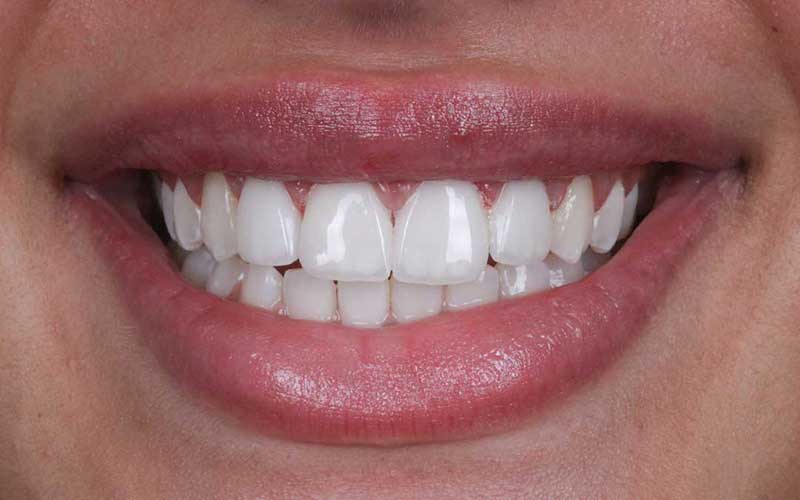 After Veneers