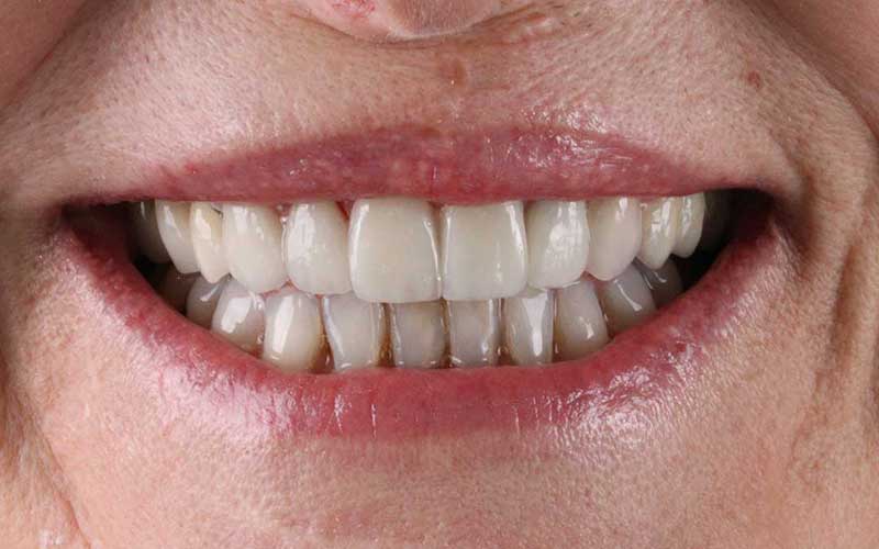 After Veneers